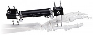 [Hot Item] Wrist Fixator-- Unilateral Nondetachable External Fixation System