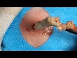 BEST Pimple Popping // Big Cystic Acne Blackheads // Whiteheads Removal / Squeezing Pimples / H#046