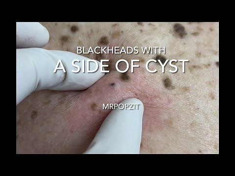 Blackheads with a side of cyst.Blackhead extractions and cyst excision with closure.Cyst dissection