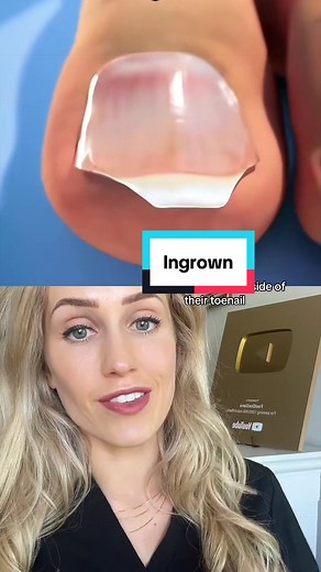 How to Cut Toenails Correctly to Prevent Ingrowns