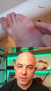 362K views · 2.5K reactions | Dermatologist reacts to big infected splinter removal! #dermreacts #doctorreacts #splinter #satisfying | Dr. Dustin Portela, Dermatologist | Facebook
