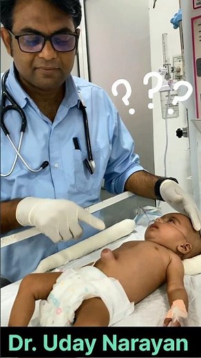 Umbilical Hernia in baby #baby #hospital