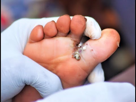 ANTI-JIGGER CAMPAIGN KIPCHIRIA EDITION