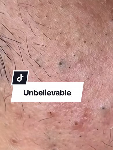 #blackhead #blackheadsss #blackheadsremover #supersatisfying #satisfyingvideos
