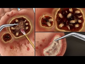 Scary Scene! Human Foot Is Full Of Maggots |인간의 발에는 구더기가 가득합니다 | ASMR Maggot Removal Animation