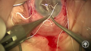 IOL Exchange With Gore-Tex-Sutured AO60 IOL - Eyetube