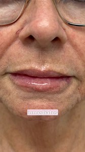 1.2K views | Hablamos sobre los rellenos de labios, que son...