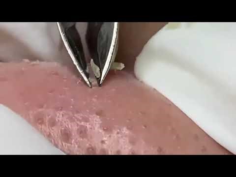 Skincare & Blackhead Removal #6 #skincare #blackheads #tweezers #acne