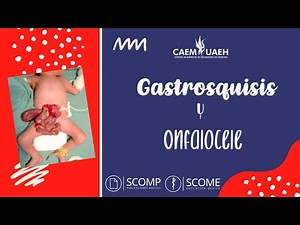 Gastroschisis and omphalocele