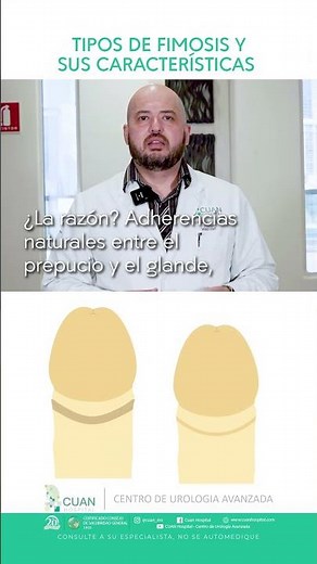 How is phimosis classified?