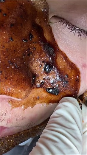 黑头粉刺清洁步骤：去黑头解压视频实录