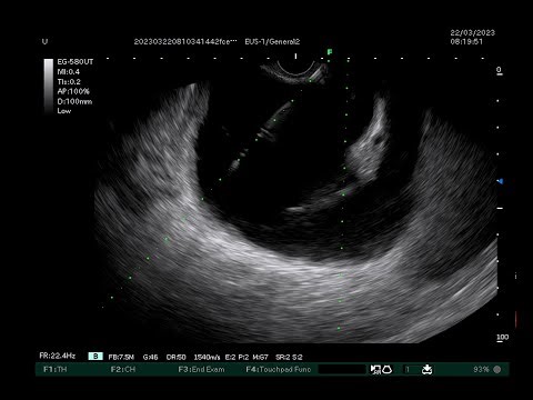 EUS CYSTOGASTROSTOMY
