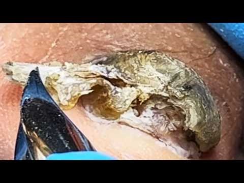 Deformed Toenails That Look Like Bridges【Podiatry Clinic】