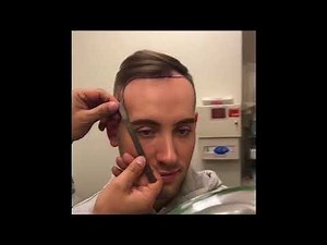 NeoGraft Hair Transplant Procedure - Part 1 | Dr. David Rapaport NYC