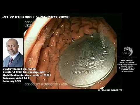 Endoscopic procedure for foreign body removal (Coin removal)