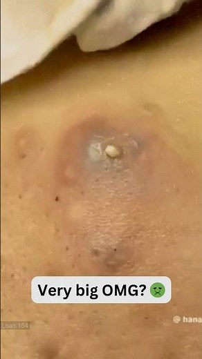 Large Blackheads Extraction Big Cystic Acne Blackheads&Whiteheads Removal Pimple Popping #1111 2026