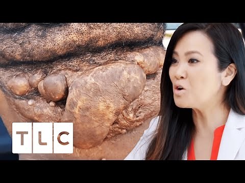 Bump On Man's Neck Bleeds And Leaks Pus | Dr. Pimple Popper Before The Pop