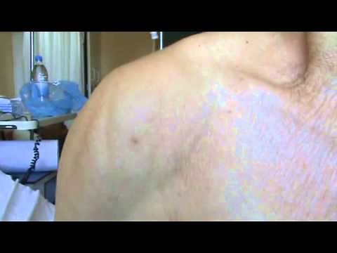 Muscle Twitching and Spasms | NEJM