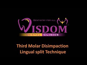 Third Molar Disimpaction Lingual split Technique