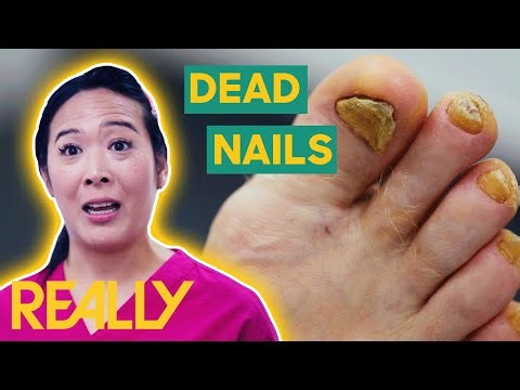 Removing Yellow Nails And Fixing A Deformed Toe | The Bad Foot Clinic