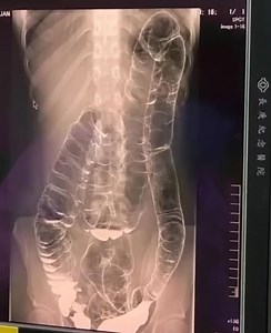 168K views · 127 reactions | This is an X-ray image of a young woman who suffered from chronic constipation. One day, after experiencing continuous symptoms for over two weeks, she went for a medical check-up and received the X-ray results shown below... | Feedy Video | Facebook