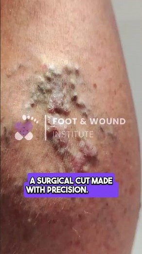 Types of Wounds Explained 🩹🔍 | Foot & Wound Institute