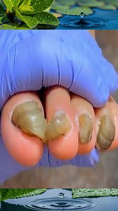 Toenail Cleaning 366 | Toenail 99