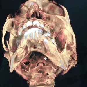 Large Mandibular Radiolucent Lesion -?odontogenic Keratocyst Slow growing lesion first noticed one week ago by this 33 years old lady.She has mild paresthesia on the left side of the chin. Local dentist has done some kind of incision and drainage without taking a CT or even an OPG.Pain in the left body of mandible on palpation reassures the Cone Beam CT Scan finding of a pathological fracture. We are planning surgical enucleation with peripheral osteotomy and chemical cauterization after multipl