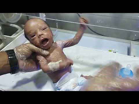 3rd Day Update – Collodion Baby in NICU Progressing Slowly