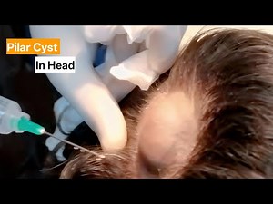 “Pilar Cyst Excision Surgery | Complete Step by Step Guide” | @SurgicalSeekers