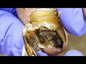 Ah, What's Inside This Toenail Coal【Podiatry Clinic】