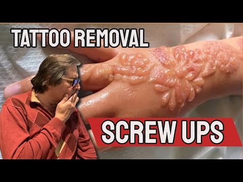 Laser Tattoo Removal Screw Ups
