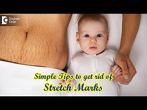 GET RID OF SEVERE STRETCH MARKS FOREVER – Know From Expert - Dr. Amee Daxini | Doctors' Circle