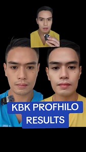 My Profhilo results 🌟💥 Profhilo is an injectable treatment used for skin rejuvenation and hydration. It consists of a high concentration of hyaluronic acid, which is a naturally occurring substance in the body that helps maintain skin hydration and elasticity. Unlike traditional fillers that add volume to specific areas, Profhilo spreads under the skin to improve overall skin quality by stimulating collagen and elastin production. Key Benefits: Hydration: Deeply hydrates the skin, improving te