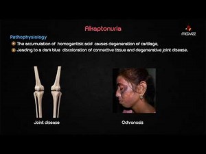 Ochronosis (or Alkaptonuria) - Usmle step 1 lecture