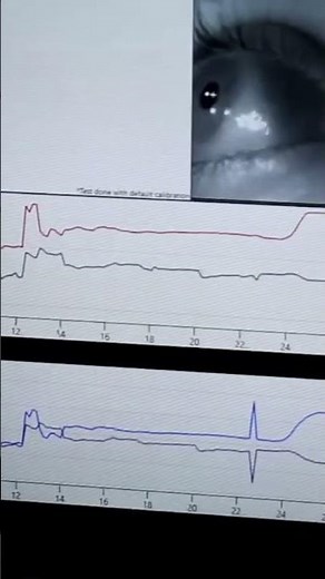 187.electronystagmography #tests for vertigo #ENG #audiology