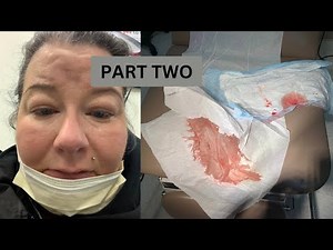 (PART 2) BARTHOLIN’S CYST REMOVAL & RECOVERY