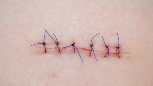 How Long Does It Take for Stitches to Dissolve? (5 Tips for Healing)