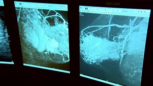 'Stage Zero' Breast Cancer: New Study Casts Doubt on Early Intervention