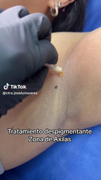 Eleva tu autoestima con este tratamiento 💜 #skintok #treatment #manchas #hiperpigmentacion #piel #fyp #ecuador