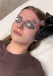 Removing my ex’s name from my face😭 #gasbabyizzy #tattooremoval #facetattoo