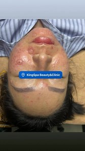 KingSpa Beauty&Clinic on Reels | Facebook