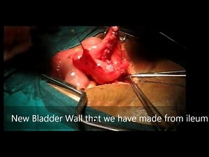 Bladder Augmentation Cystoplasty Surgical Steps