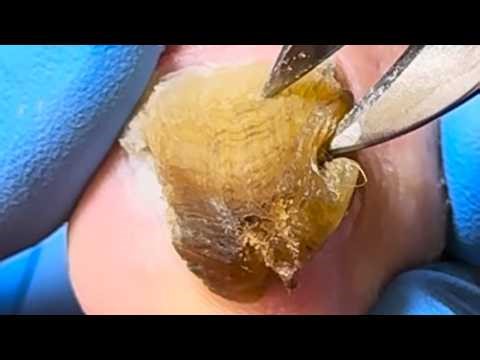 Toenail Trimming Is Like Trimming Stone, Professional Pedicure【Xue Yidao】