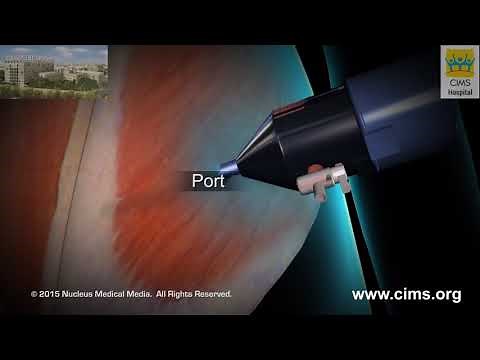 Laparoscopic Ventral Incisional Hernia Repair – CIMS Hospital