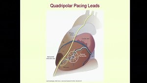Advancements in Cardiac Resynchronization Therapy