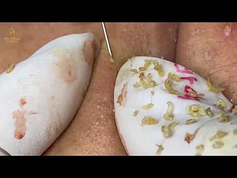 Pimple Popper Pops Best Blackhead In New (157) | Loan nguyen