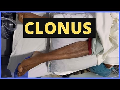 Clonus | Video demonstration & Explanation (in 3 mins) | Neurology | OSCE