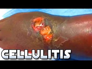 Cellulitis, Cellulitis, Cellulitis!