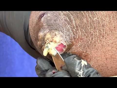 Big jiggers on Nandi's elbows and fingers - see whole jiggers pulled out, subscribe @.net